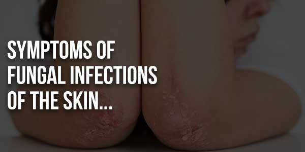 Symptoms-Of-Fungal-Infections-Of-The-Skin